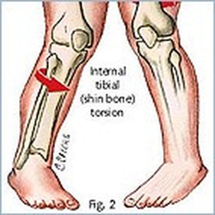 Picture1 Children’s Podiatry Part 2 - In-Toeing in Children