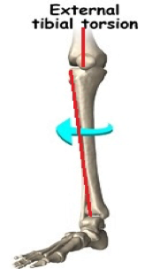 Picture1-1 Children's Podiatry Part 3 - Out – Toeing in Children