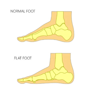 Picture1-1 Children's Podiatry Part 3 - Out – Toeing in Children