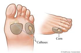 cornscalluses Callus and Corns
