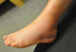 Picture1-300x207 Ankle Sprains