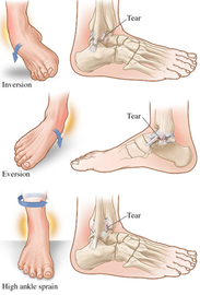 Picture1-300x207 Ankle Sprains