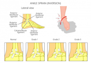 Picture1-300x207 Ankle Sprains