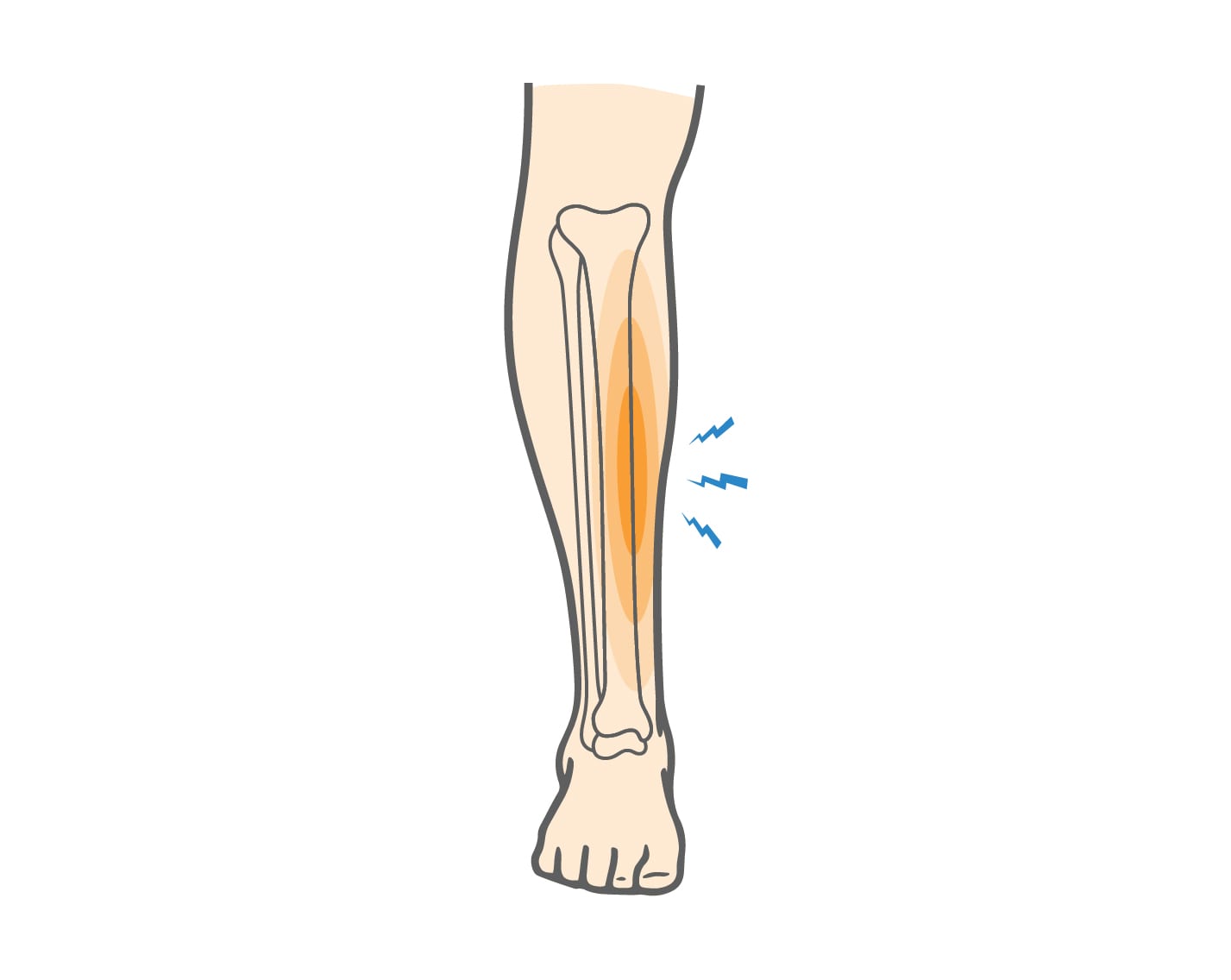 Shin-Splints-2 Shin Splints