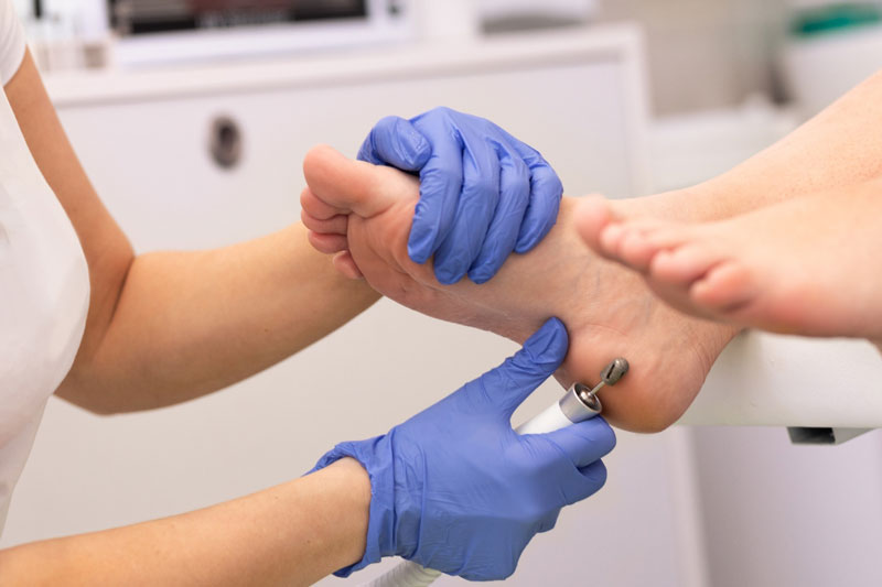 corns-and-calluses Corns / Callus