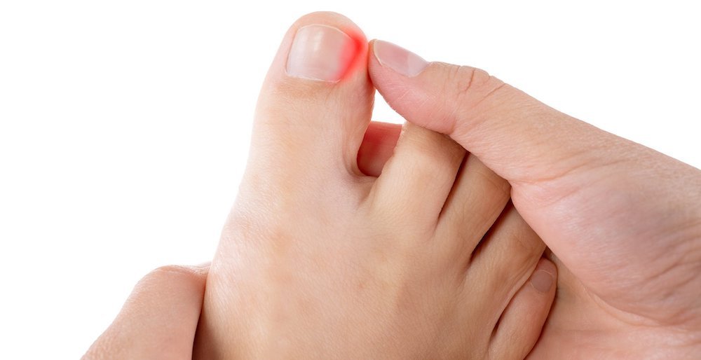 ingrown-toenail Ingrown Toenails